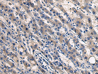 Immunohistochemistry of paraffin-embedded Human liver cancer tissue using COL17A1 Polyclonal Antibody at dilution of 1:50 (×200)