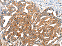 Immunohistochemistry of paraffin-embedded Human liver cancer tissue using NOG Polyclonal Antibody at dilution of 1:40 (×200)