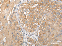 Immunohistochemistry of paraffin-embedded Human esophagus cancer tissue using SNX6 Polyclonal Antibody at dilution of 1:50 (×200)