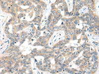 Immunohistochemistry of paraffin-embedded Human liver cancer tissue using SNX6 Polyclonal Antibody at dilution of 1:50 (×200)