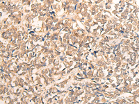 Immunohistochemistry of paraffin-embedded Human lung cancer tissue using CPS1 Polyclonal Antibody at dilution of 1:35 (×200)