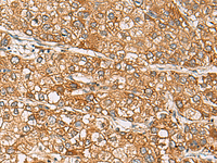 Immunohistochemistry of paraffin-embedded Human liver cancer tissue using DCAF12 Polyclonal Antibody at dilution of 1:65 (×200)
