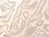 Immunohistochemistry of paraffin-embedded Human thyroid cancer tissue using ADGRE3 Polyclonal Antibody at dilution of 1:35 (×200)
