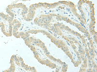 Immunohistochemistry of paraffin-embedded Human thyroid cancer tissue using EVI2B Polyclonal Antibody at dilution of 1:40 (×200)