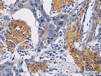 Immunohistochemistry of paraffin-embedded Human esophagus cancer tissue using FAM20C Polyclonal Antibody at dilution of 1:45 (×200)