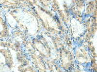 Immunohistochemistry of paraffin-embedded Human thyroid cancer tissue using CTDP1 Polyclonal Antibody at dilution of 1:70 (×200)