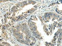 Immunohistochemistry of paraffin-embedded Human colorectal cancer tissue using NPVF Polyclonal Antibody at dilution of 1:65 (×200)