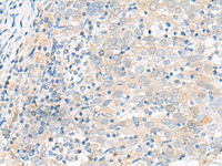 Immunohistochemistry of paraffin-embedded Human cervical cancer tissue using FGR Polyclonal Antibody at dilution of 1:70 (×200)