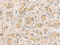 Immunohistochemistry of paraffin-embedded Human liver cancer tissue using SQSTM1 Polyclonal Antibody at dilution of 1:40 (×200)