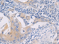 Immunohistochemistry of paraffin-embedded Human esophagus cancer tissue using GALR3 Polyclonal Antibody at dilution of 1:50 (×200)