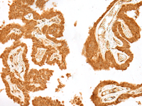 Immunohistochemistry of paraffin-embedded Human thyroid cancer tissue using GANC Polyclonal Antibody at dilution of 1:55 (×200)