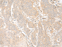 Immunohistochemistry of paraffin-embedded Human esophagus cancer tissue using GLIS1 Polyclonal Antibody at dilution of 1:40 (×200)