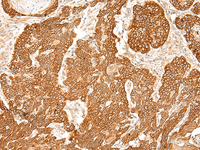 Immunohistochemistry of paraffin-embedded Human esophagus cancer tissue using SLC6A9 Polyclonal Antibody at dilution of 1:50 (×200)