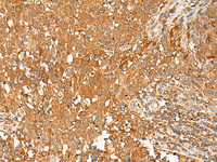Immunohistochemistry of paraffin-embedded Human cervical cancer tissue using GPR1 Polyclonal Antibody at dilution of 1:50 (×200)