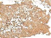 Immunohistochemistry of paraffin-embedded Human lung cancer tissue using PRLHR Polyclonal Antibody at dilution of 1:70 (×200)