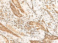 Immunohistochemistry of paraffin-embedded Human esophagus cancer tissue using HOXC13 Polyclonal Antibody at dilution of 1:60 (×200)