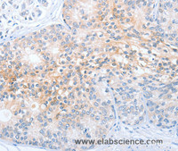 Immunohistochemistry of paraffin-embedded Human prostate cancer tissue using OX2R Polyclonal Antibody at dilution 1:70