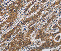 Immunohistochemistry of paraffin-embedded Human gastric cancer using DHRS3 Polyclonal Antibody at dilution of 1:30