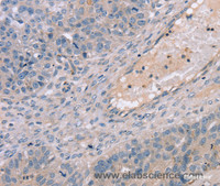 Immunohistochemistry of paraffin-embedded Human breast cancer using TERT Polyclonal Antibody at dilution of 1:35