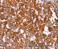 Immunohistochemistry of paraffin-embedded Human thyroid cancer using HAS1 Polyclonal Antibody at dilution of 1:30