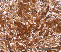 Immunohistochemistry of paraffin-embedded Human gastric cancer using HAS1 Polyclonal Antibody at dilution of 1:30