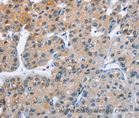 Immunohistochemistry of paraffin-embedded Human liver cancer using ATXN1 Polyclonal Antibody at dilution of 1:40