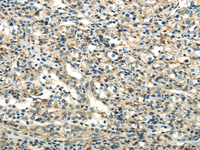 Immunohistochemistry of paraffin-embedded Human prostate cancer using DLAT Polyclonal Antibody at dilution of 1/40