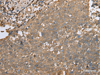 Immunohistochemistry of paraffin-embedded Human cervical cancer tissue using ALKBH8 Polyclonal Antibody at dilution of 1:25 (×200)