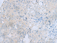 Immunohistochemistry of paraffin-embedded Human ovarian cancer tissue using MSI2 Polyclonal Antibody at dilution of 1:70 (×200)