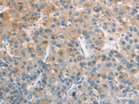 Immunohistochemistry of paraffin-embedded Human liver cancer tissue using ZAP70 Polyclonal Antibody at dilution of 1:50 (×200)