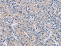 Immunohistochemistry of paraffin-embedded Human liver cancer tissue using CREBZF Polyclonal Antibody at dilution of 1:50 (×200)