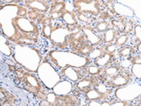 Immunohistochemistry of paraffin-embedded Human thyroid cancer tissue using ATG16L1 Polyclonal Antibody at dilution of 1:45 (×200)