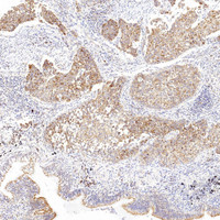 Immunohistochemistry analysis of paraffin-embedded human lung cancer using CYCS Polyclonal Antibody at dilution of 1:1000.