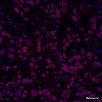 Immunofluorescence analysis of paraffin-embedded human liver cancer using GSK3 beta Polyclonal Antibody at dilution of 1:300.