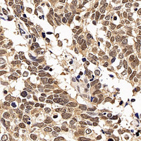 Immunohistochemistry analysis of paraffin-embedded human lung cancer using p27 Polyclonal Antibody at dilution of 1:200.