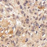 Immunohistochemistry analysis of paraffin-embedded human lung cancer using FOXO1 Polyclonal Antibody at dilution of 1:300.