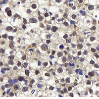 Immunohistochemistry analysis of paraffin-embedded human orchidoncus using Cyclin E1 Polyclonal Antibody at dilution of 1:400.