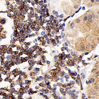 Immunohistochemistry analysis of paraffin-embedded human stomach cancer using CD192 Polyclonal Antibody at dilution of 1:300.