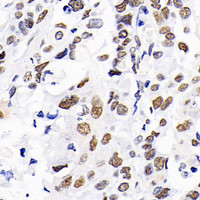 Immunohistochemistry analysis of paraffin-embedded human lung cancer using DNMT1 Polyclonal Antibody at dilution of 1:300.