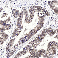 Immunohistochemistry analysis of paraffin-embedded human colon cancer using JMJD6 Polyclonal Antibody at dilution of 1:1000.