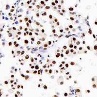 Immunohistochemistry analysis of paraffin-embedded human lung cancer using Proliferating Cell Nuclear Antigen Polyclonal Antibody at dilution of 1:1000.