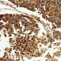 Immunohistochemistry analysis of paraffin-embedded human liver cancer using IGF1 Polyclonal Antibody at dilution of 1:500.