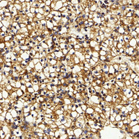 Immunohistochemistry analysis of paraffin-embedded human kidney cancer using IGF1 Polyclonal Antibody at dilution of 1:500.