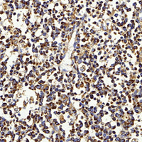 Immunohistochemistry analysis of paraffin-embedded human lymph nodes cancer using IGF1 Polyclonal Antibody at dilution of 1:500.