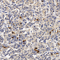 Immunohistochemistry analysis of paraffin-embedded A549 in Human breast using CASP3 Polyclonal Antibody at dilution of 1:400.