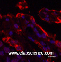 Immunofluorescence analysis of Human lung cancer tissue using Galectin 3 Monoclonal Antibody at dilution of 1:200.