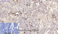 Immunohistochemistry of paraffin-embedded Human lung cancer tissue using CD45 Monoclonal Antibody at dilution of 1:200.