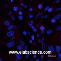 Immunofluorescence analysis of Human liver cancer tissue using CD45 Monoclonal Antibody at dilution of 1:200.