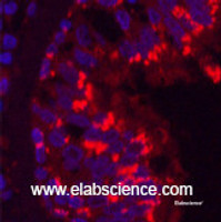 Immunofluorescence analysis of Human lung cancer tissue using CD68 Monoclonal Antibody at dilution of 1:200.