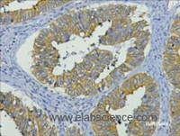 Immunohistochemistry of paraffin-embedded Human colon cancer tissue using CK-19 Monoclonal Antibody at dilution of 1:200.